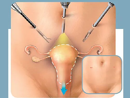 عمل جراحی هیسترکتومی با لاپراسکوپی