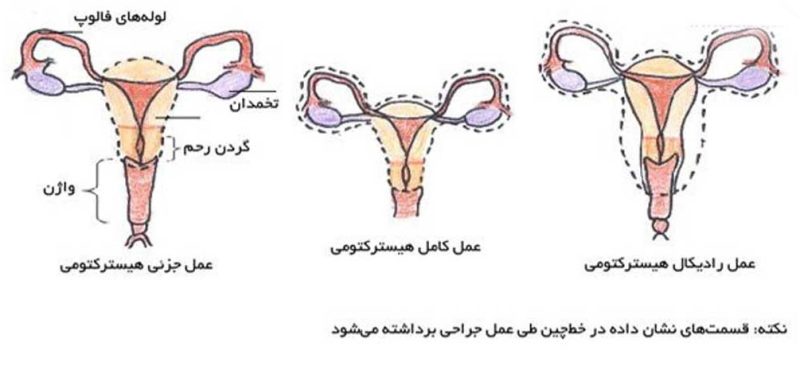 عمل هیسترکتومی