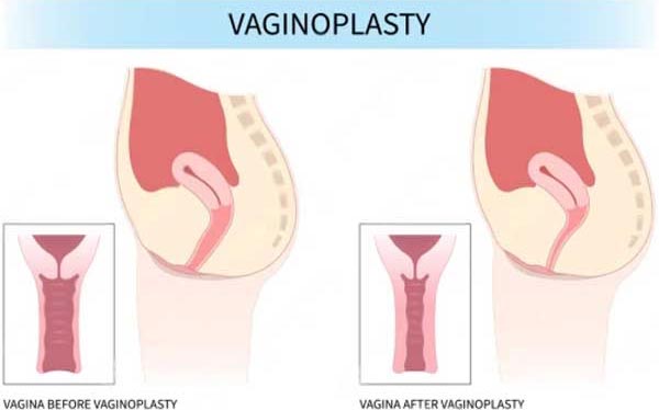 قبل و بعد عمل واژینوپلاستی