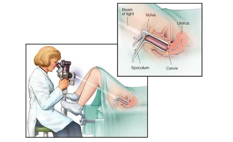 نحوه انجام کولپوسکوپی