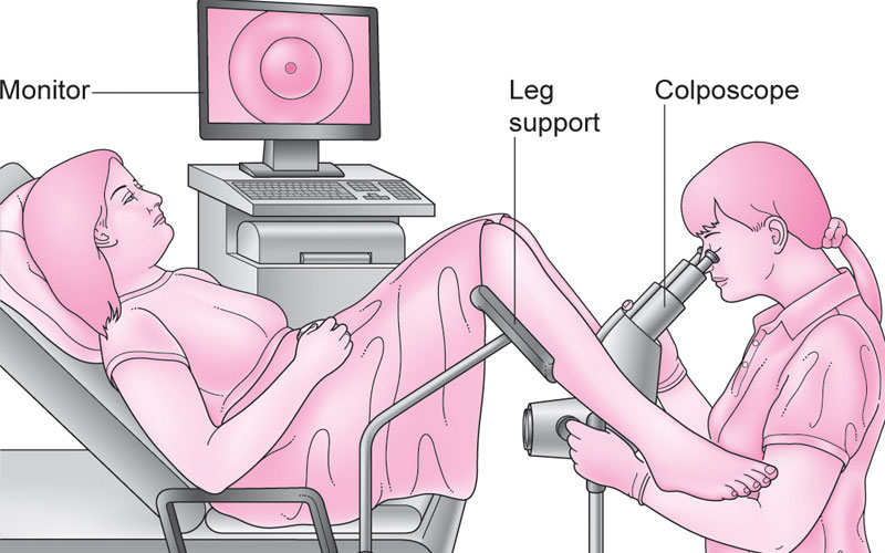 کولپوسکوپی در شمال تهران