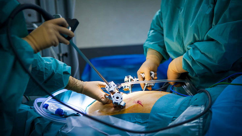 عمل جراحی هیسترکتومی رحم