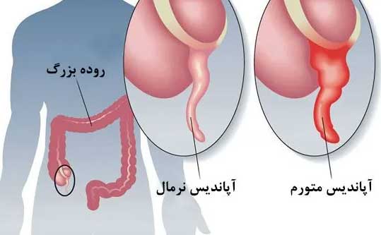 هزینه لاپاراسکوپی آپاندیس در سال 1403