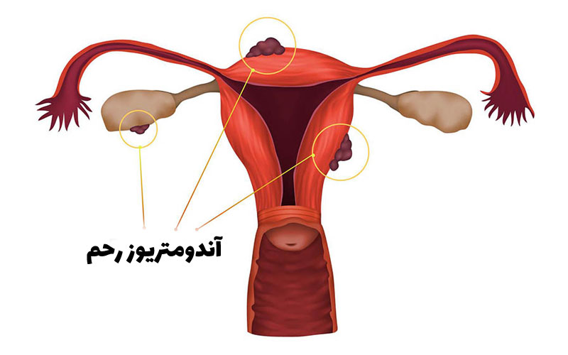 آندومتریوز رحم