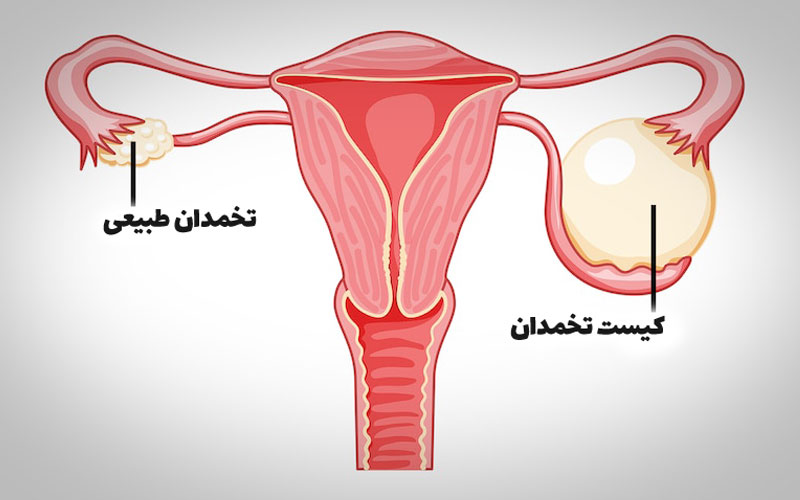 برداشتن کیست تخمدان