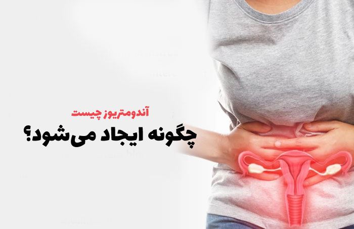 اندومتریوز چیست و چه علائمی دارد؟