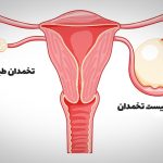 برداشتن کیست تخمدان