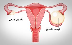 برداشتن کیست تخمدان