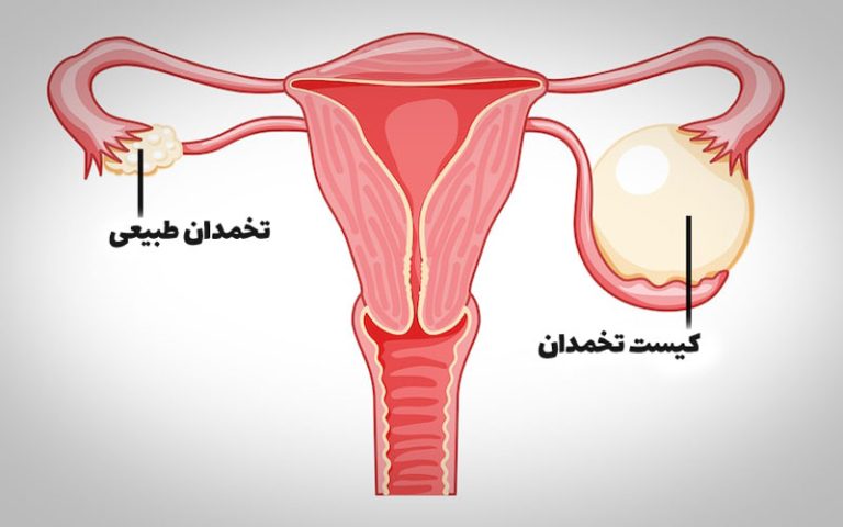 برداشتن کیست تخمدان
