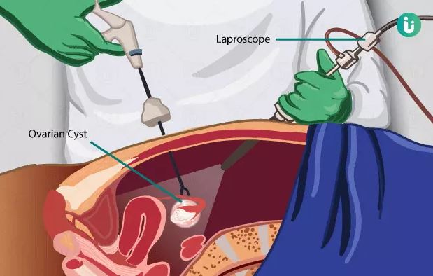 برداشتن کیست تخمدان با لاپاراسکوپی