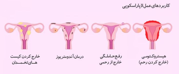 کاربردهای عمل لاپاراسکوپی