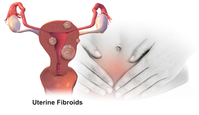 بهترین دکتر فیبروم رحم در تهران