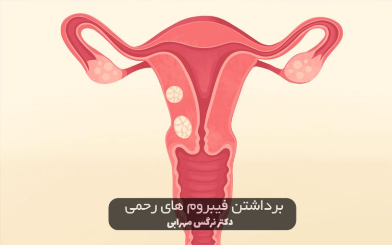 جراحی برداشتن فیبروم