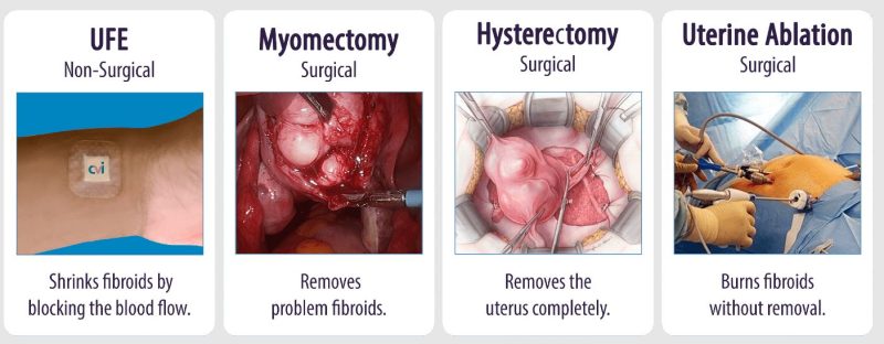 روش های جراحی فیبروم های رحمی