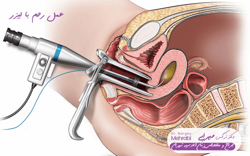 عمل رحم با لیزر