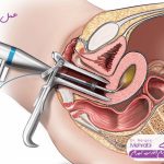 عمل رحم با لیزر