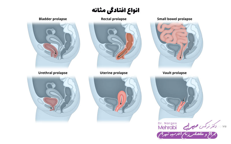 انواع علایم افتادگی مثانه