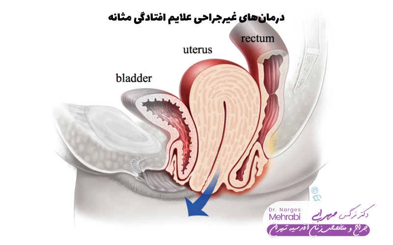 درمان‌های غیرجراحی علایم افتادگی مثانه