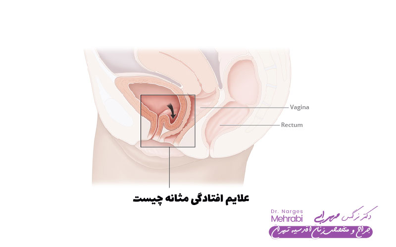 علایم افتادگی مثانه چیست