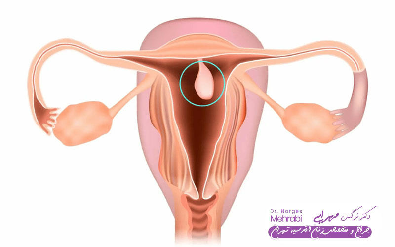 عود پولیپ رحم بعد از برداشتن