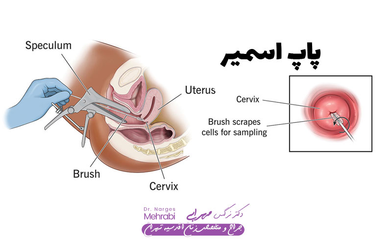 تشخیص HPV با پاپ اسمیر 5 تشخیص اچ پی وی با پاپ اسمیر