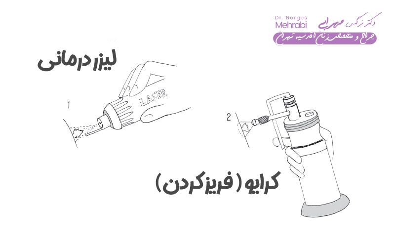 تشخیص زگیل تناسلی 5 تشخیص زگیل تناسلی در مردان