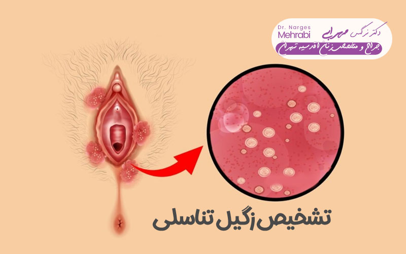 تشخیص زگیل تناسلی