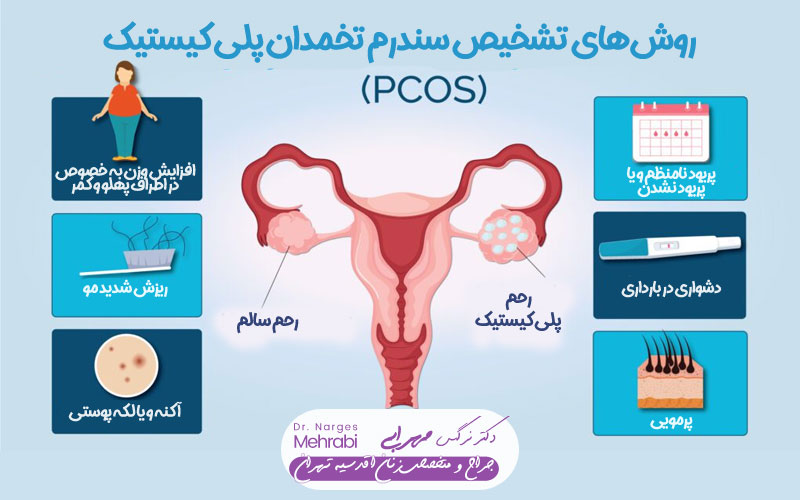 روش‌های تشخیص سندرم تخمدان پلی کیستیک