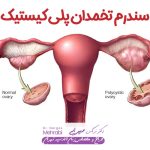سندرم تخمدان پلی کیستیک