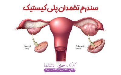 سندرم تخمدان پلی کیستیک