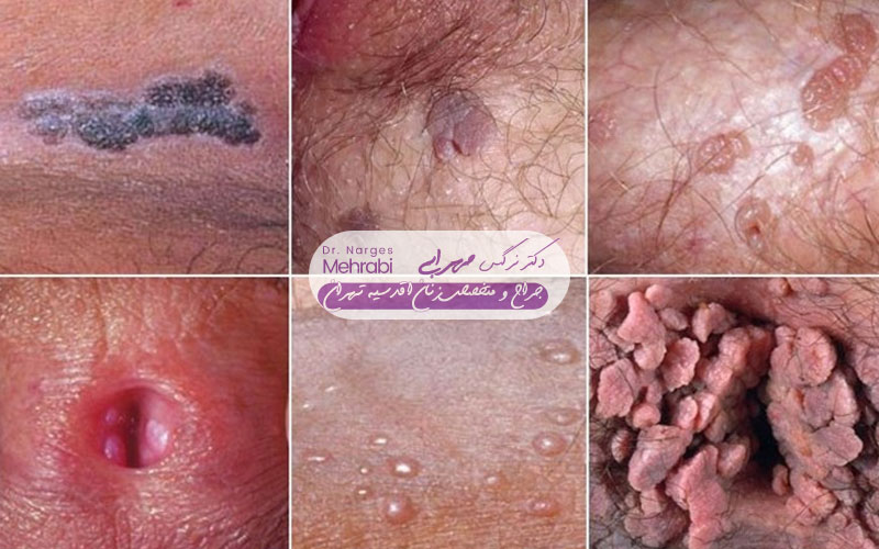تشخیص زگیل تناسلی 4 علائم زگیل تناسلی در زنان عکس