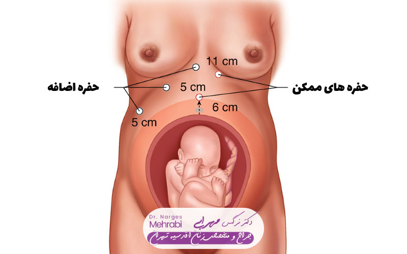 بارداری بعد از عمل لاپاراسکوپی 4 تاثیر لاپاراسکوپی بر افزایش شانس بارداری