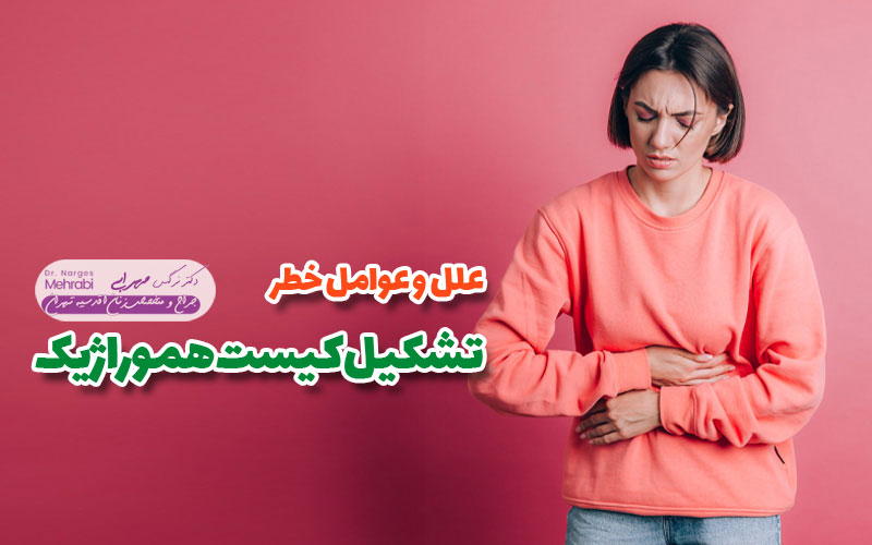 کیست هموراژیک تخمدان چیست 5 تشکیل کیست هموراژیک