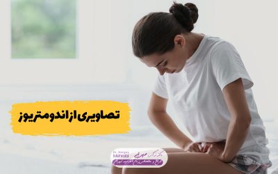 تصاویری از اندومتریوز