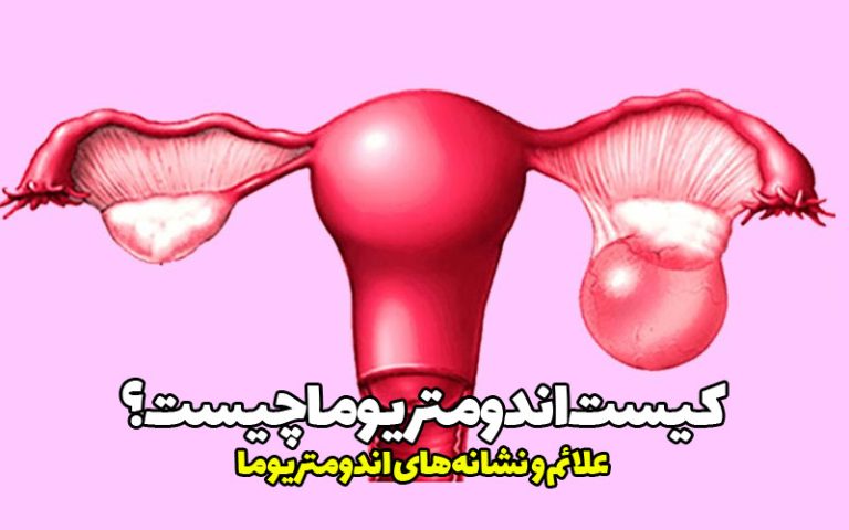 کیست اندومتریوما