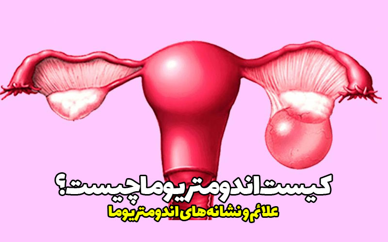 کیست اندومتریوما