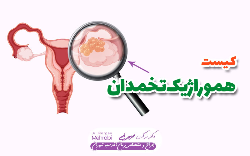 کیست هموراژیک تخمدان چیست