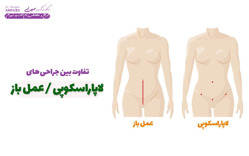 فرق لاپاراسکوپی و عمل باز رحم