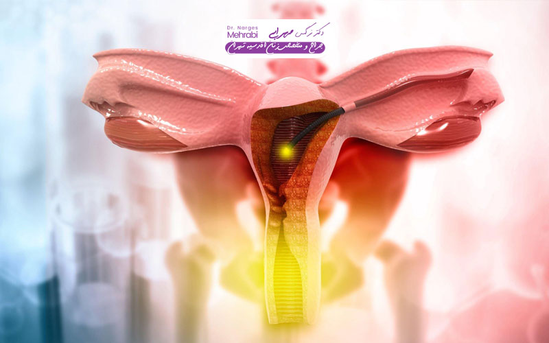 لاپاراسکوپی رحم برای ناباروری