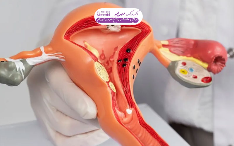 لاپاراسکوپی رحم برای ناباروری 4 لاپاراسکوپی رحم چیست و چه تفاوتی با جراحی باز دارد؟