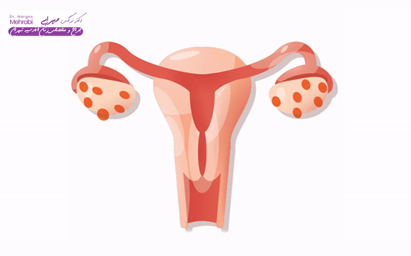 بهترین قرص برای تنبلی تخمدان 6 عوارض جانبی رایج و نکات حیاتی در مصرف داروهای PCOS