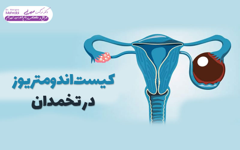 کیست اندومتریوز در تخمدان