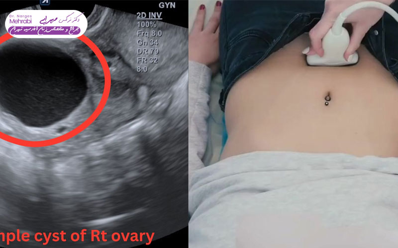بهترین زمان برای سونوگرافی رحم و تخمدان 5 ارزیابی ضخامت اندومتر و پولیپ