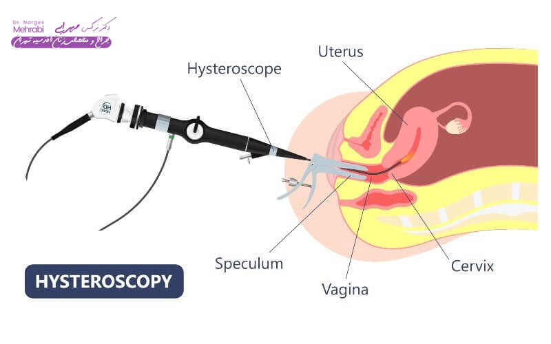 هزینه عمل هیستروسکوپی در بیمارستان دولتی