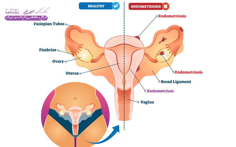 علائم آندومتریوز چیست 4 ارتباط اندومتریوز مثانه با ناباروری