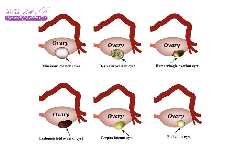 انواع کیست تخمدان
