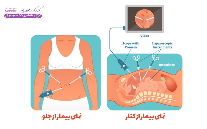 جراحی لاپاراسکوپی