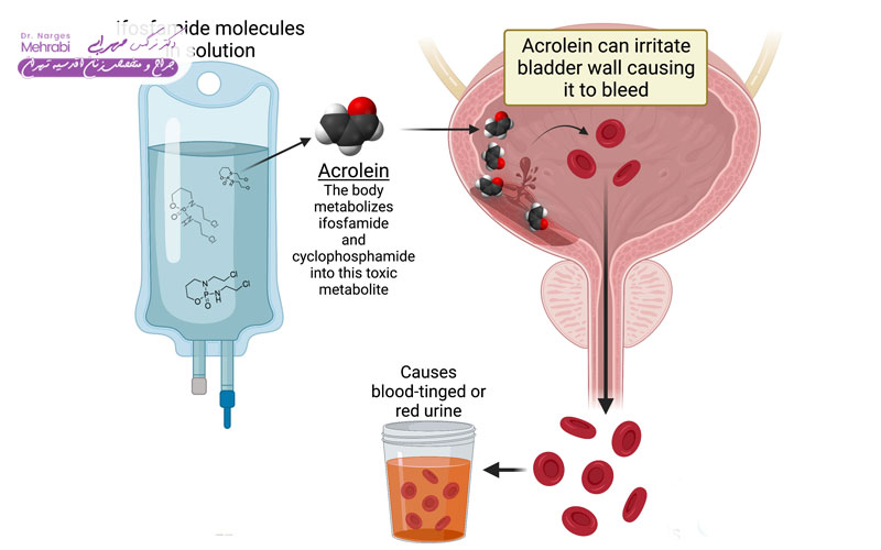 علائم اندومتریوز مثانه 4 خون در ادرار (هماچوری)