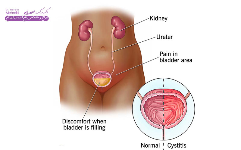 علائم اندومتریوز مثانه 3 درد و سوزش هنگام ادرار کردن (دیسوریا)