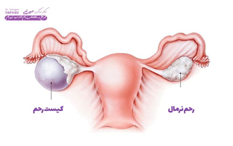 درمان کیست رحم